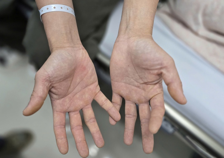 Hai vợ chồng trẻ liệt người vì hít hàng chục quả ‘bóng cười’ mỗi ngày - Ảnh 1. bóng cười - Ảnh 1.