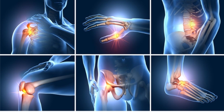 Thoái hóa khớp giai đoạn sớm: Nên bắt đầu bằng thuốc bôi tại chỗ và tập luyện - Ảnh 1.