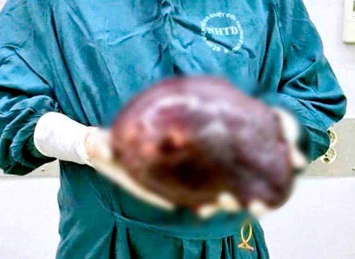 Cắt khối u gan khổng lồ nặng 2,5kg - Ảnh 1.