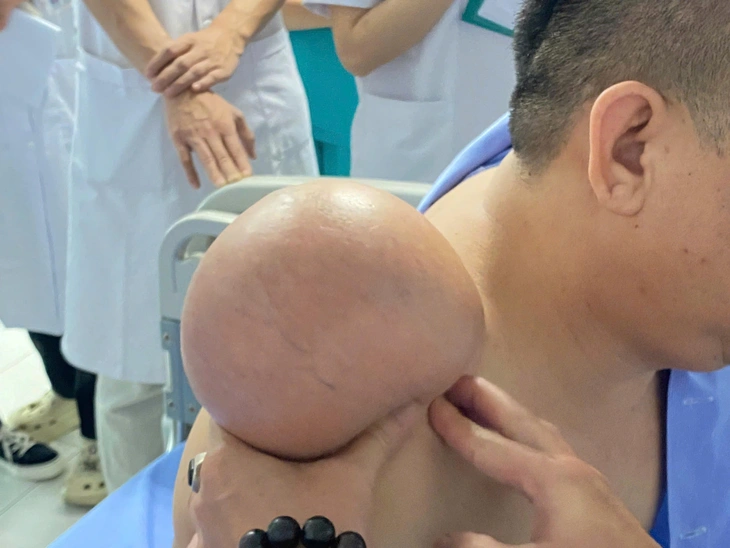 ‘Gỡ bỏ’ khối u vai khổng lồ nặng 1,5 kg  - Ảnh 1. khối u - Ảnh 1.