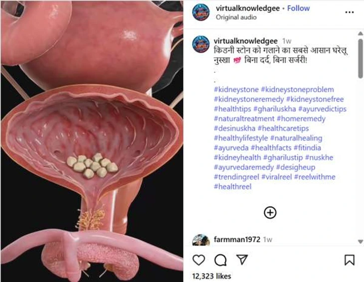 Tỏi và gừng làm tan sỏi thận trong 21 ngày? - Ảnh 2.