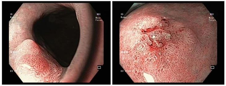 Cắt tách qua nội soi (ESD) - giải pháp an toàn, không cần phẫu thuật - Ảnh 1.