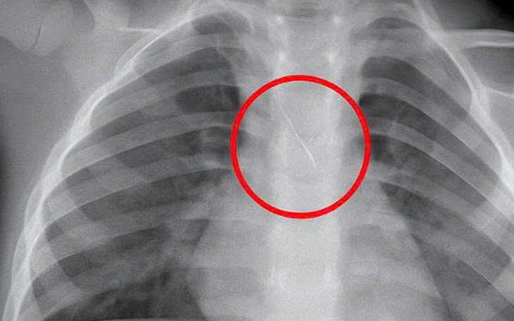 Vừa ăn vừa nói, nhiều người bị dị vật đường thở - Ảnh 2.