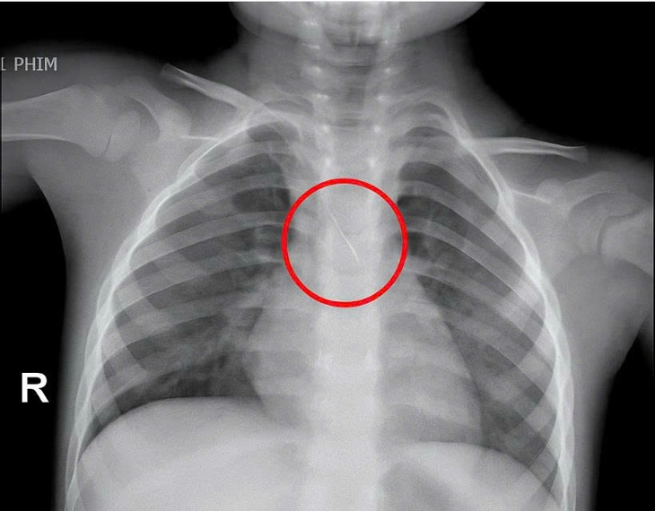 Kim chọc tủy dài 22 mm rơi vào đường thở bé trai 3 tuổi khi làm răng - Ảnh 1. làm răng - Ảnh 1.