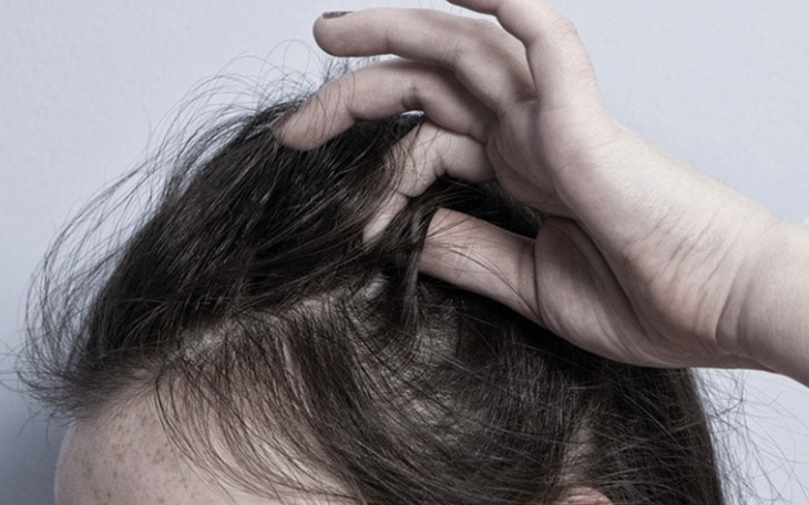 Nhổ tóc bạc cho 'đỡ ngứa mắt', coi chừng tóc không mọc lại - Ảnh 2.