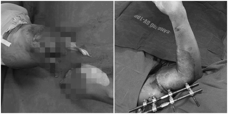 5 tiếng phẫu thuật 'trồng' lại cánh tay đứt rời cho người đàn ông - Ảnh 1. cánh tay - Ảnh 1.