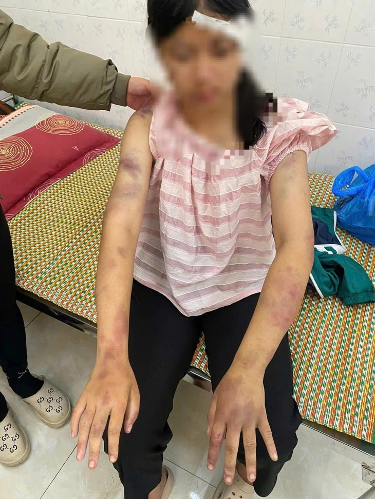 Bé gái bị bà nội, ông dượng và anh trai bà nội đánh đập dã man - Ảnh 1.