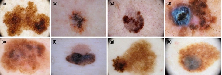 Đốm đen trên da, khi mào là dấu hiệu của ung thư da - Ảnh 1. Đốm đen trên da, khi nào là dấu hiệu của ung thư da? - Ảnh 1.