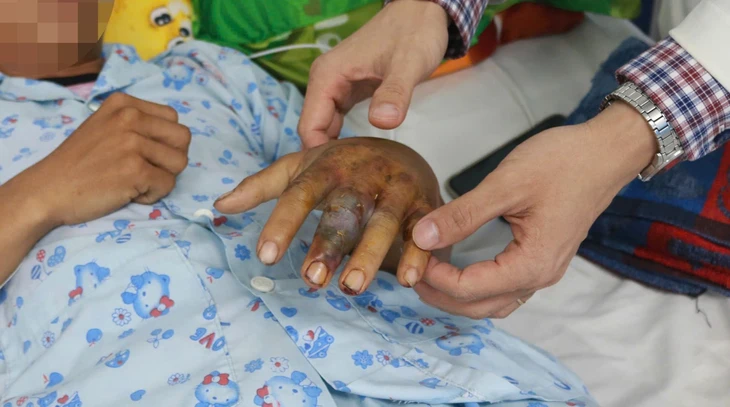 Tự đắp lá chữa rắn cắn, nam thanh niên bị nhiễm độc nặng - Ảnh 1.