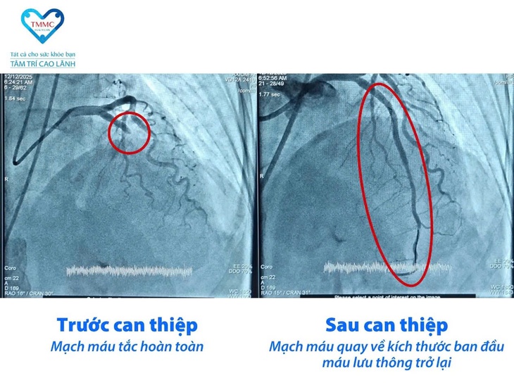 Bệnh viện Tâm Trí Cao Lãnh cứu sống 5 ca nhồi máu cơ tim cấp trong giờ vàng - Ảnh 2.