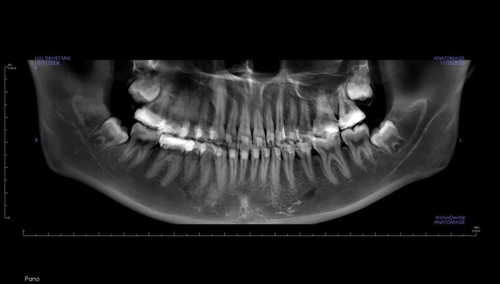 Bác sĩ hướng dẫn tránh sai lầm sau nhổ răng khôn - 'vị khách' đến muộn nhiều phiền toái - Ảnh 1.