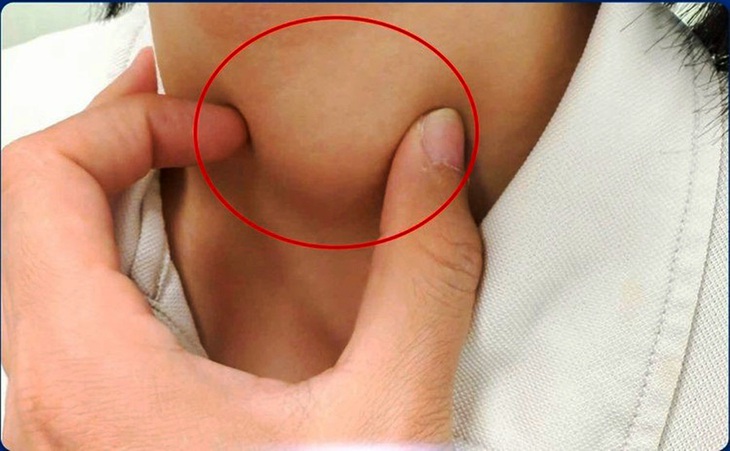 tuyến giáp - Ảnh 2.