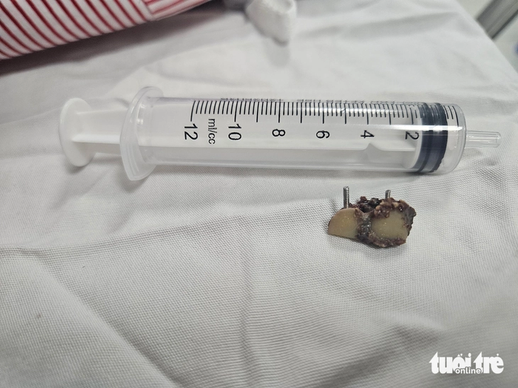 Bỗng dưng mất 2 chiếc răng, 20 năm sau bác sĩ phát hiện trong... phổi - Ảnh 3.