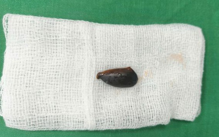 Bé trai chảy máu mũi cả tuần vì con vắt sống ký sinh trong hốc mũi - Ảnh 4.