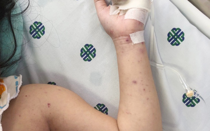 Anh quốc báo động đỏ: Dịch viêm màng não "bùng phát thần tốc"   - Ảnh 3.