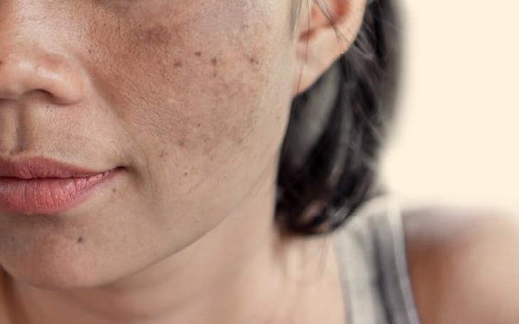 sắc tố da - Ảnh 1.