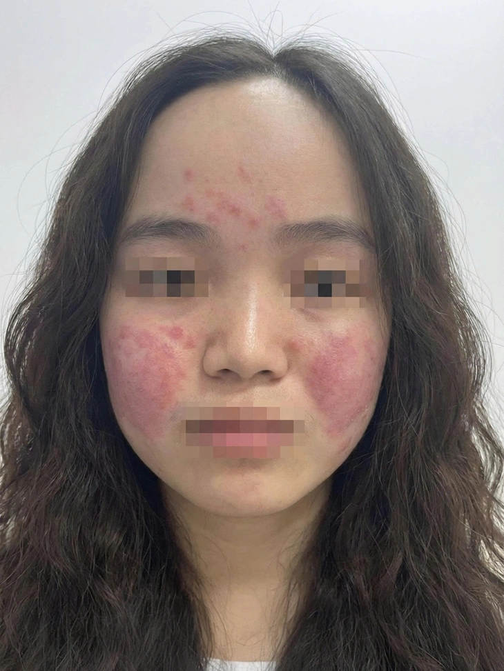 Cô gái trẻ đỏ rát toàn mặt vì ô nhiễm không khí, bác sĩ hướng dẫn cách bảo vệ da - Ảnh 1. ô nhiễm - Ảnh 1.