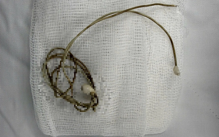 Bé trai chảy máu mũi cả tuần vì con vắt sống ký sinh trong hốc mũi - Ảnh 2.