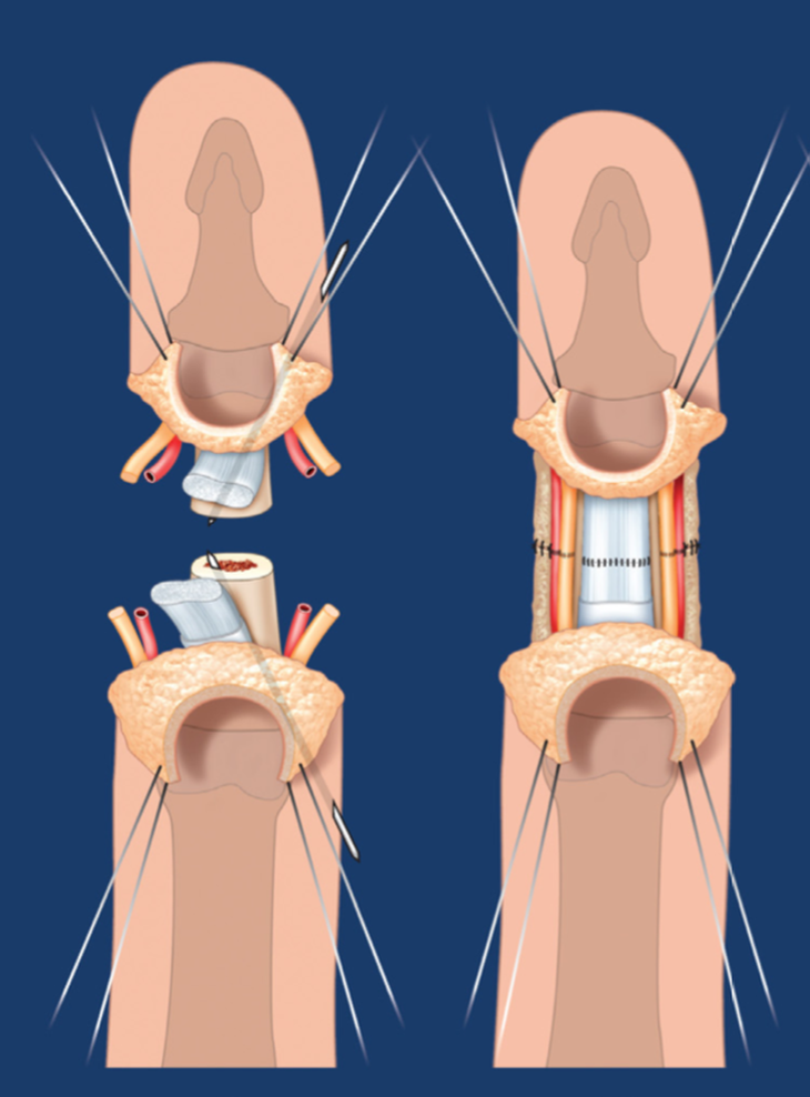 Vi phẫu thuật nối thành công ngón tay của thủy thủ tàu viễn dương bị đứt rời sau 25 giờ - Ảnh 2.
