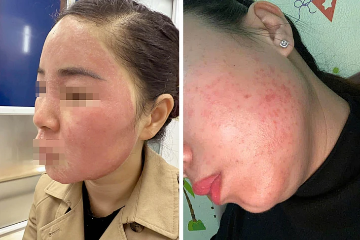 tretinoin - Ảnh 2.