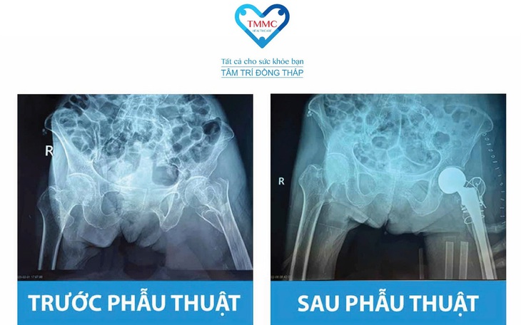 Lần đầu tiên tại miền Trung: Bệnh nhân được thay khớp háng và xương đùi nhân tạo - Ảnh 2.