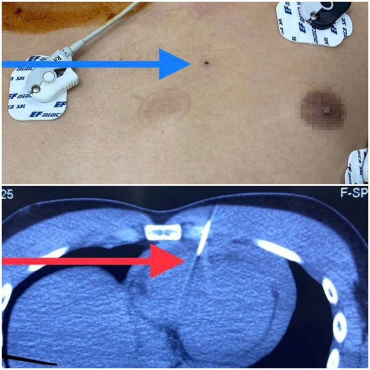 Hi hữu, chạy đua cứu sống nam thanh niên bị đinh đâm thủng tim - Ảnh 2.