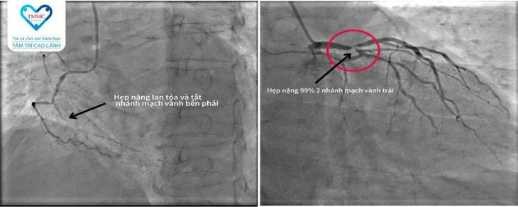 BVĐK Tâm Trí Cao Lãnh cấp cứu thành công nhiều bệnh nhân nhồi máu cơ tim nặng - Ảnh 2.