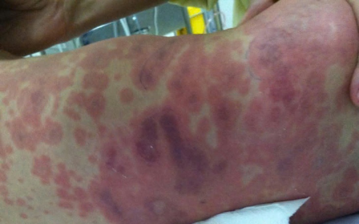 Một trường hợp bệnh nhân nghi bị mắc bệnh viêm não mô cầu ở Phú Quốc - Ảnh 2.