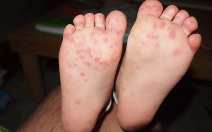 Viện Pasteur TP.HCM hoàn thành 2 nghiên cứu thử nghiệm lâm sàng vắc xin Tay chân miệng - Ảnh 2.