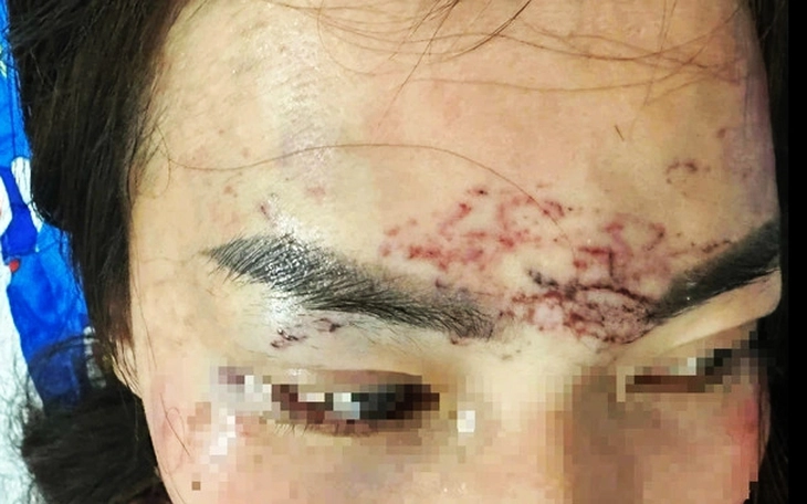 Khởi tố vụ án đánh ghen bằng cách xăm lên mặt, tạt axit xôn xao dư luận ở Cà Mau - Ảnh 2.