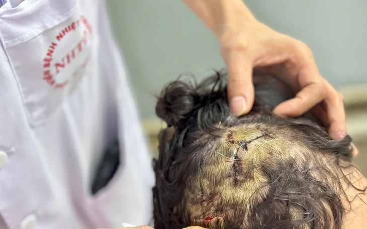 Bé trai bị chó nhà người quen cắn rách đầu - Ảnh 2.