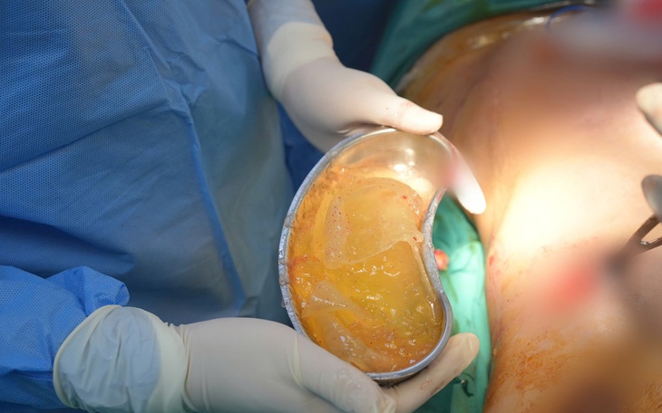 Phát hiện túi ngực vỡ vụn sau 5 năm: Bác sĩ cảnh báo biến chứng âm thầm dễ bỏ qua - Ảnh 3.