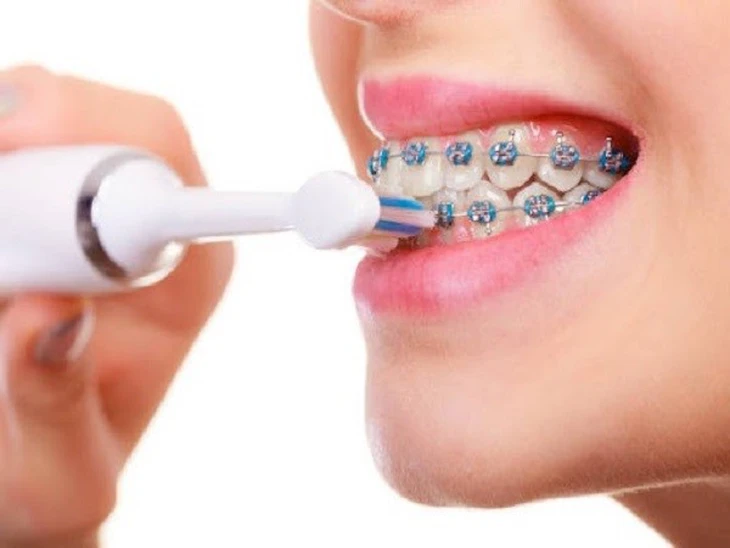 Ăn gì, vệ sinh răng thế nào khi đang niềng răng? - Ảnh 1. niềng răng - Ảnh 1.