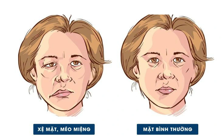 Thời tiết chuyển lạnh, cẩn trọng liệt dây thần kinh số 7, đột quỵ - Ảnh 2.