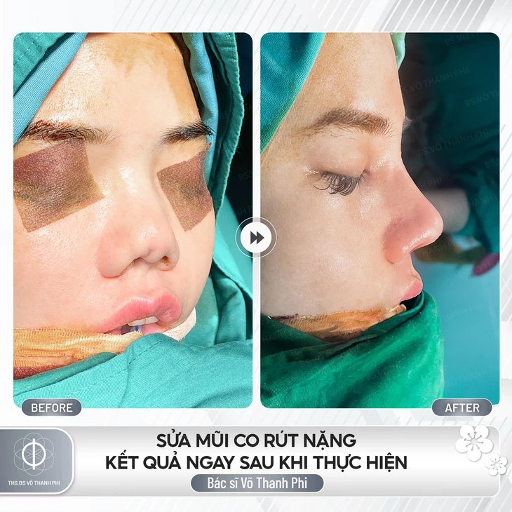 Mũi viêm - Ảnh 1.