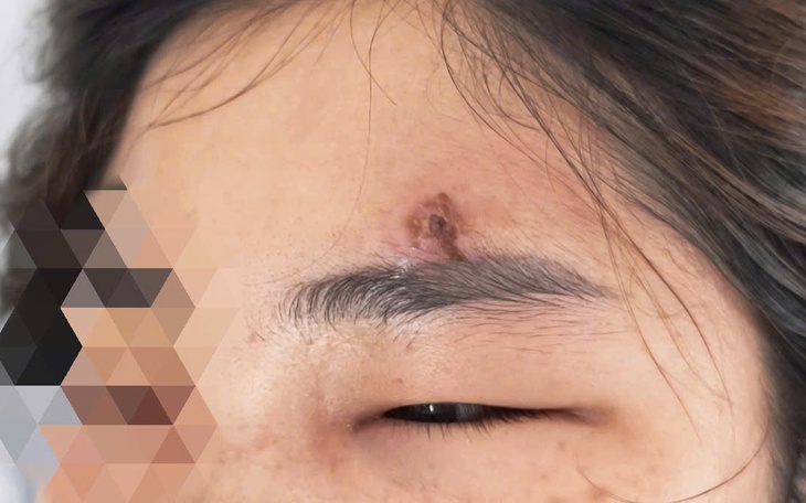 Hiểm họa từ việc nặn mụn: Da mặt bị nhiễm trùng, sẹo rỗ - Ảnh 3.