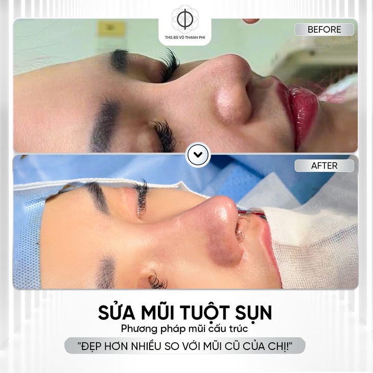 Mũi viêm - Ảnh 2.