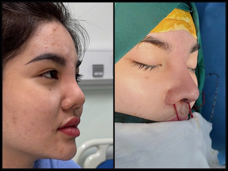 Mũi viêm - Biến chứng nguy hiểm cần nhận biết sớm và xử lý đúng cách - Ảnh 3.