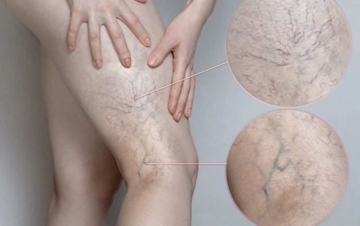 Chân đau nhức, mạch máu lộ rõ cảnh báo bệnh lý gì? - Ảnh 1. Chân đau nhức, mạch máu lộ rõ cảnh báo bệnh lý đang đe dọa 1/3 người trưởng thành - Ảnh 1.