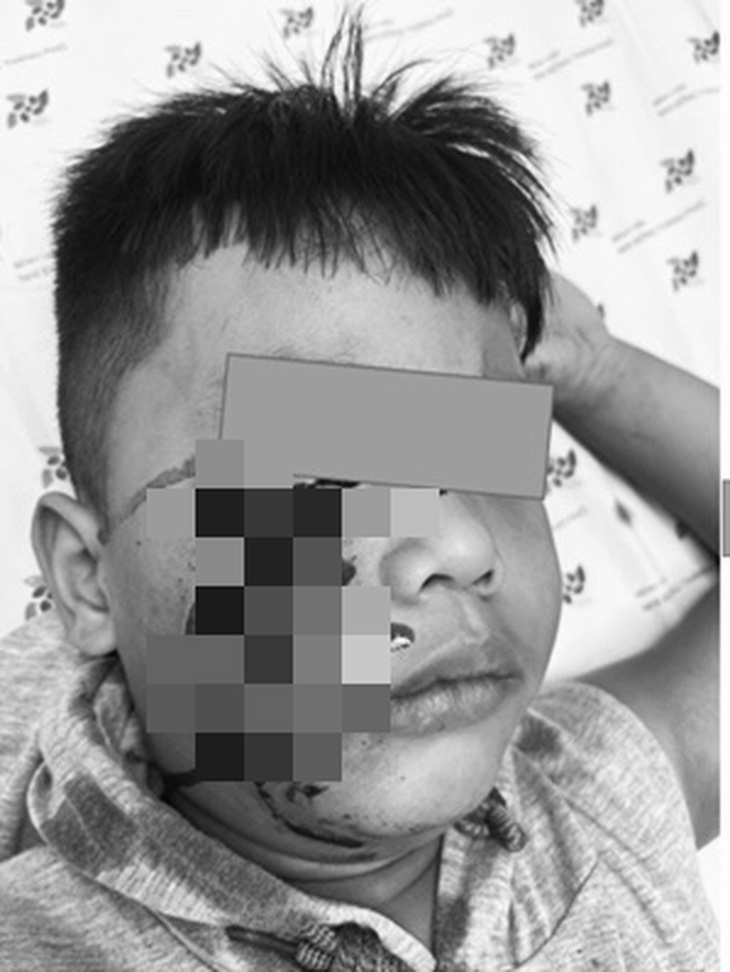 Bé 5 tuổi bị chó cắn hàng chục vết thương sâu ở mặt, phải khâu 20 mũi - Ảnh 1.