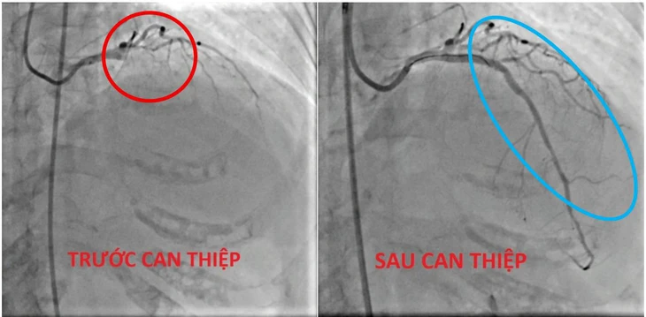 nhồi máu cơ tim - Ảnh 1.