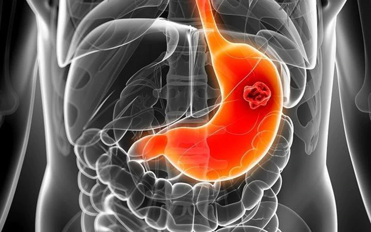 Viêm loét dạ dày có phải do ăn cay mà ra? - Ảnh 2.