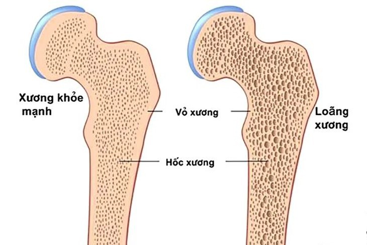 Làm gì để phòng ngừa bệnh loãng xương? - Ảnh 1. Làm gì để phòng ngừa bệnh loãng xương? - Ảnh 1.