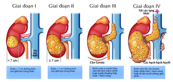 Ung thư thận: Xu hướng gia tăng đáng báo động - Ảnh 1.