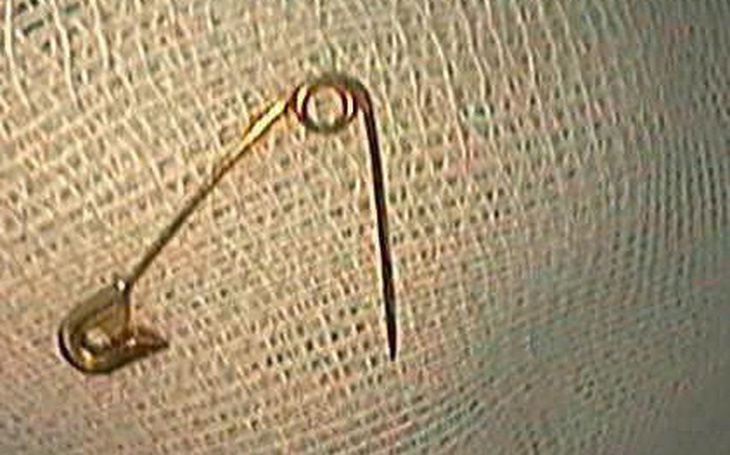 Mổ lấy cán cây lau nhà dài 15cm nằm trong trực tràng của thanh niên  - Ảnh 2.
