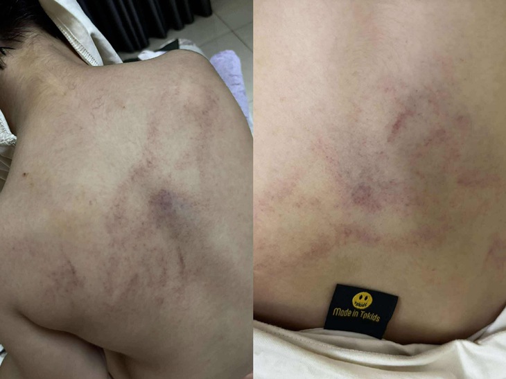 Gia đình tố cô giáo mầm non đánh, kéo lê, ném bé gái 4 tuổi vào tường- Ảnh 1. Gia đình tố cô giáo mầm non đánh, kéo lê, ném bé gái 4 tuổi vào tường - Ảnh 1.