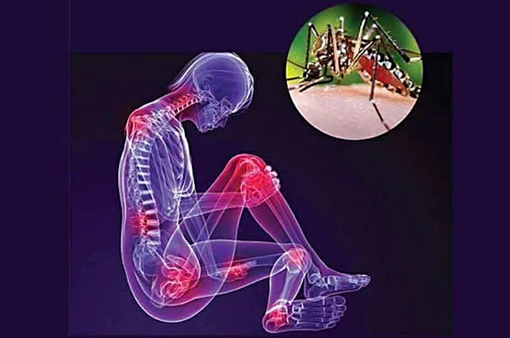 Bệnh Chikungunya là gì, triệu chứng như thế nào? - Ảnh 1. Chikungunya - Ảnh 1.