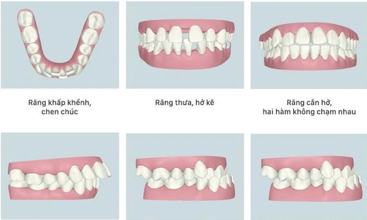 niềng răng - Ảnh 1.