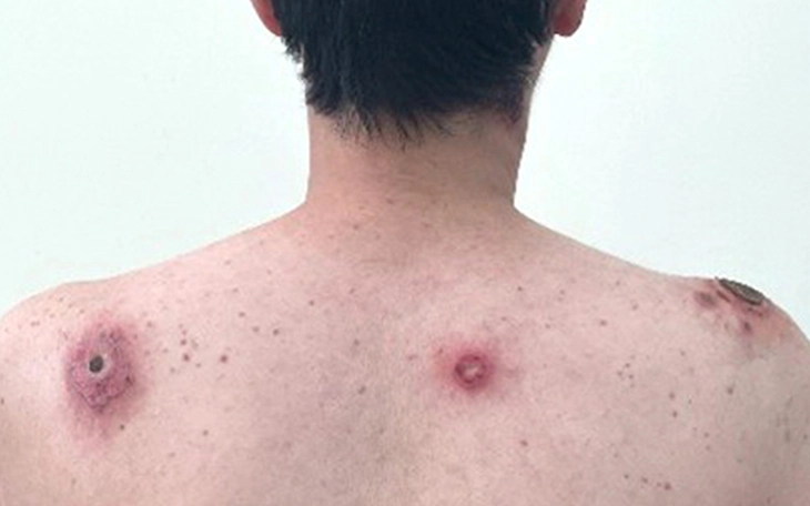 Người đàn ông 65 tuổi mắc giang mai thần kinh khiến mắt mờ đột ngột - Ảnh 2.