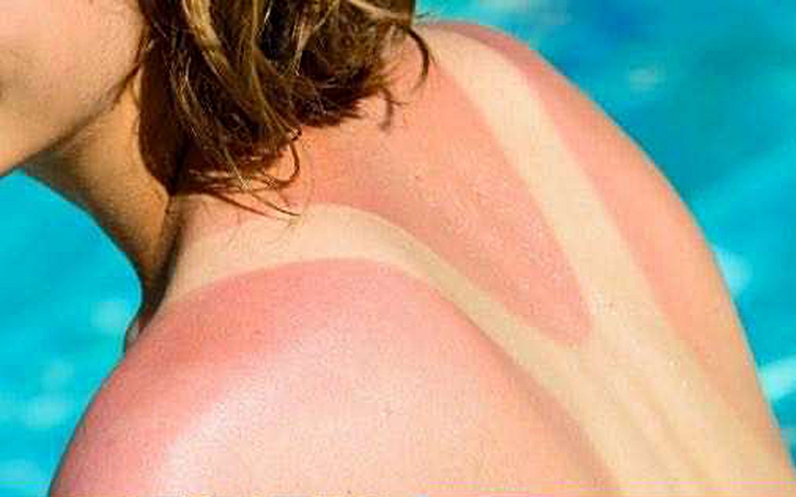  Ung thư da tiềm ẩn từ tổn thương không đau, không ngứa có thể di căn não, phổi - Ảnh 3.